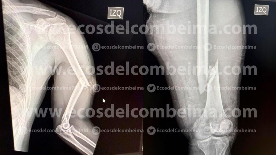 fracturas