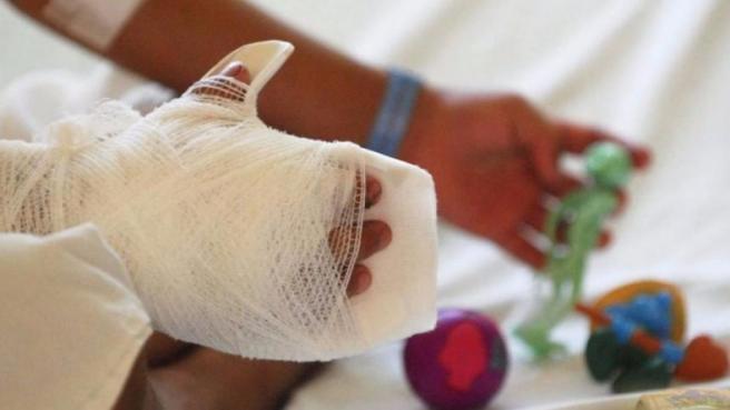 Aumenta el número de quemados por pólovira en 2025.