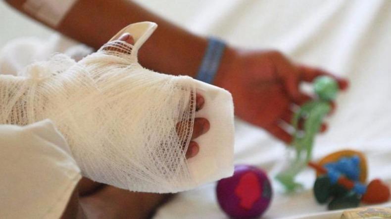 Aumenta el número de quemados por pólovira en 2025.