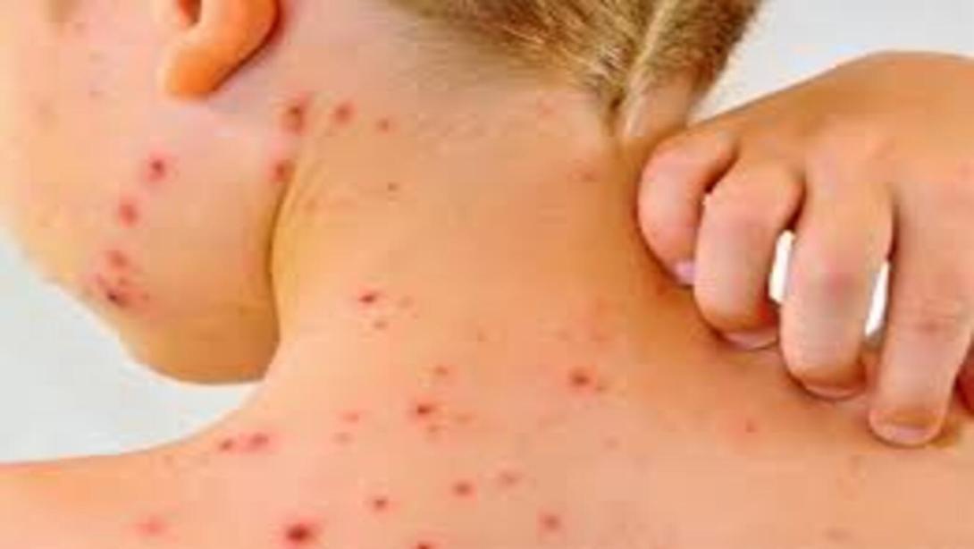 Las autoridades sanitarias buscan blindar al páis contra el asarampíón.